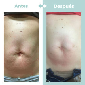 Fisioterapia dermatofuncional adbominal en Clínica Atrium Valladolid