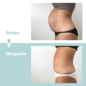 Fisioterapia dermatofuncional diástasis en Clínica Atrium Valladolid