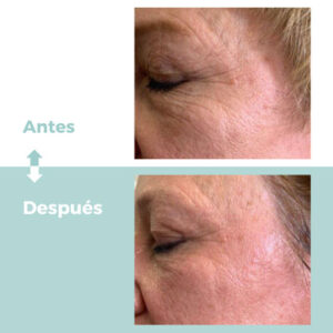 Fisioterapia dermatofuncional facial en Clínica Atrium Valladolid